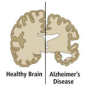 Alzheimer's disease vs healthy brain