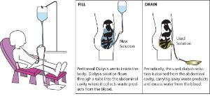 Science Take-Out® Kidney Dialysis