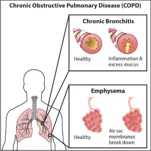 Science Take-Out® Lung Disease