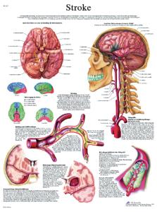 3B Scientific® Stroke Chart