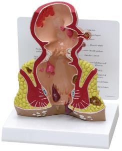 GPI Anatomicals® Rectum Model